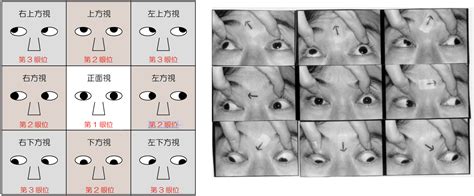 馬竇氏鏡|[問題] 雙眼眼球震顫+內斜(眼位不正)